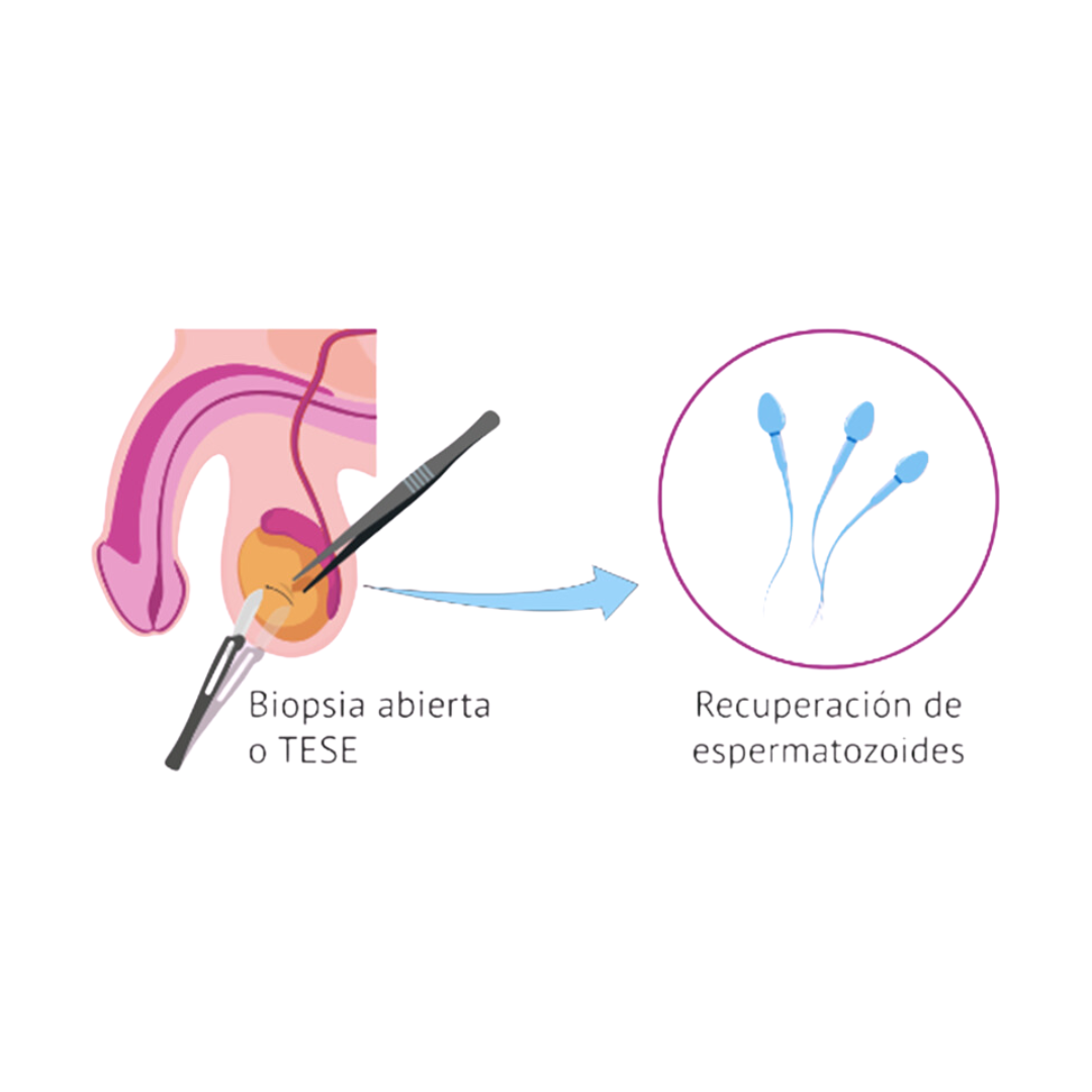 Dibujo detallado del procedimiento de micro TESE, mostrando la extracción de espermatozoides de los testículos.