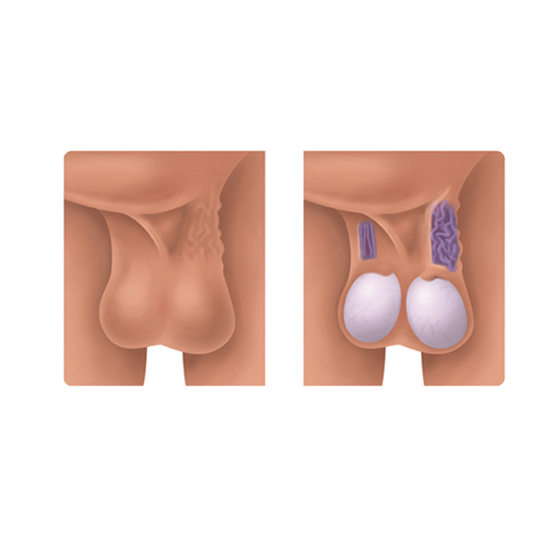 Dibujo detallado de un varicocele, mostrando la dilatación de las venas en el escroto.