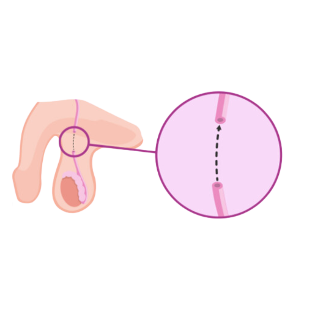 Dibujo detallado de una vasectomía microquirúrgica, mostrando el procedimiento paso a paso.