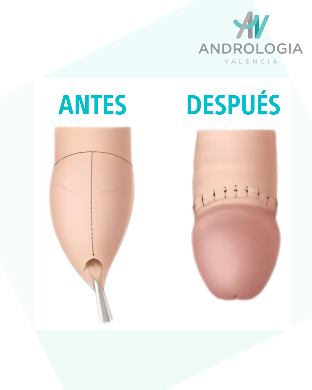 Ilustración médica del antes y después del tratamiento de fimosis en Valencia, mostrando la retracción completa del prepucio tras la circuncisión sin bisturí